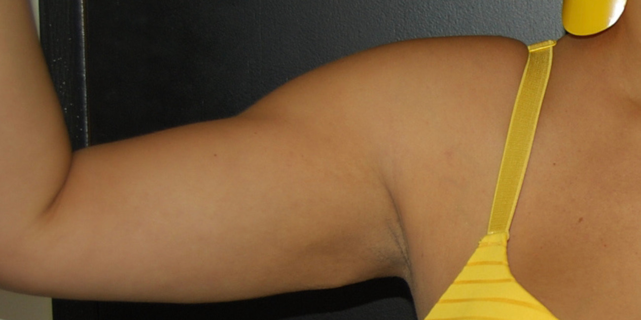 Arm Lift Surgery, After