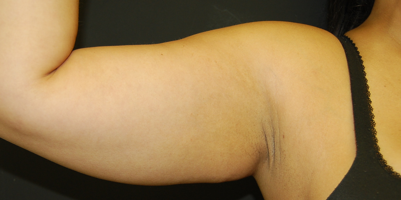 Arm Lift Surgery, Before
