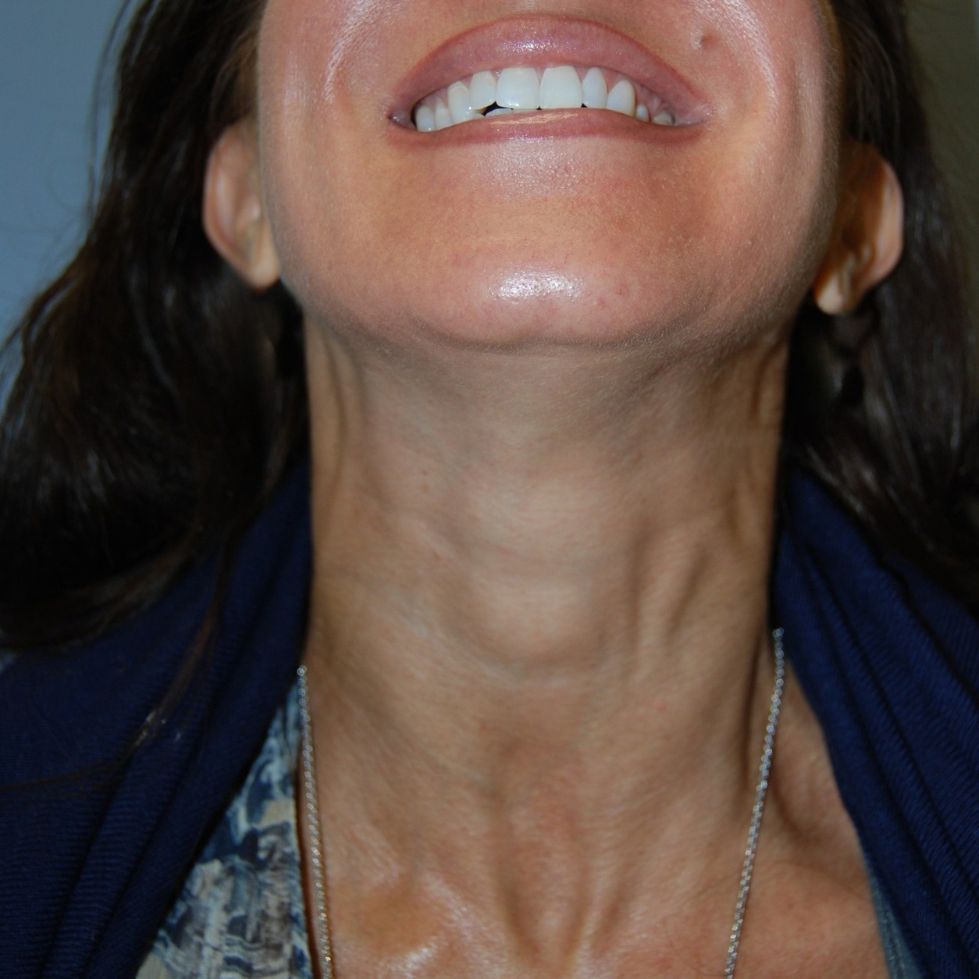 Botox & Dermal Fillers, After