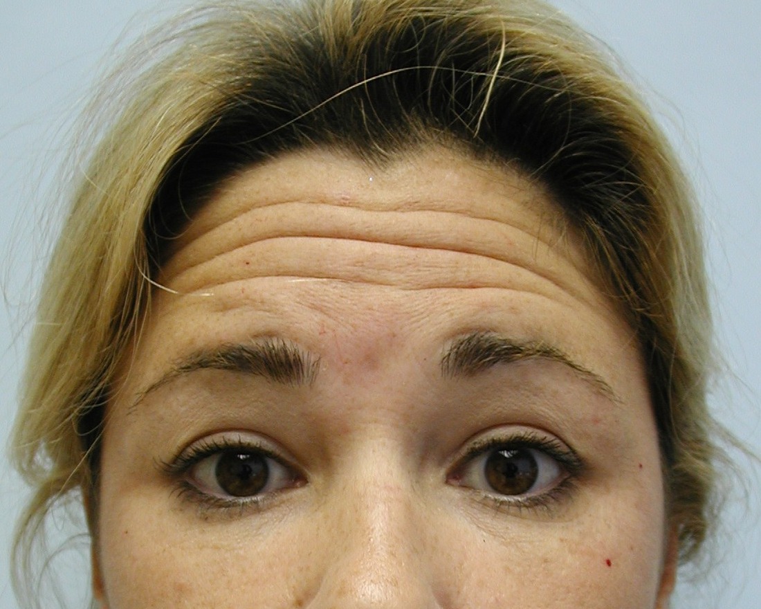 Botox & Dermal Fillers, Before