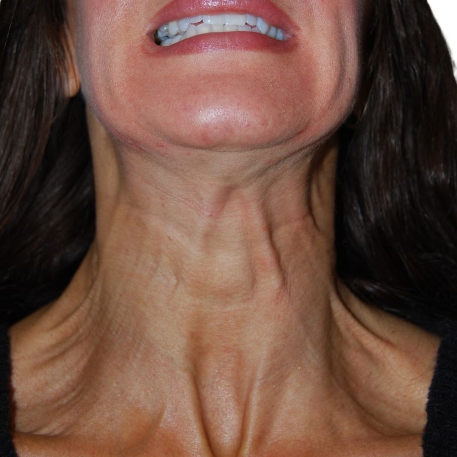 Botox & Dermal Fillers, Before