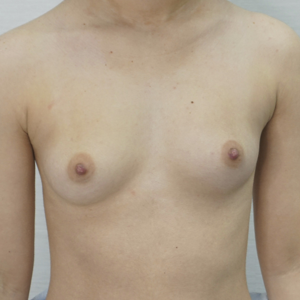 Breast Augmentation, Before