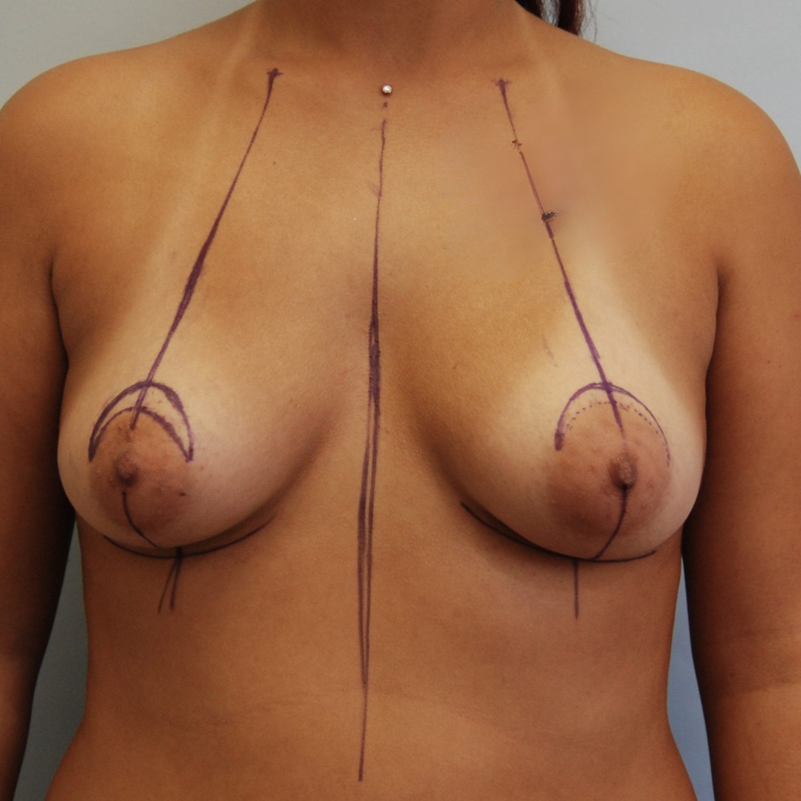 Breast Augmentation, Before