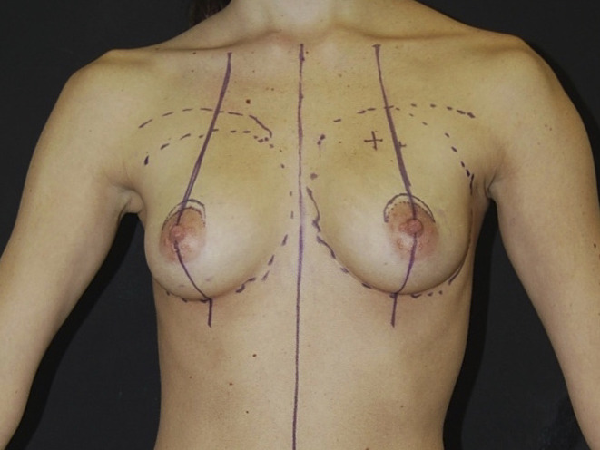 Breast Augmentation, Before