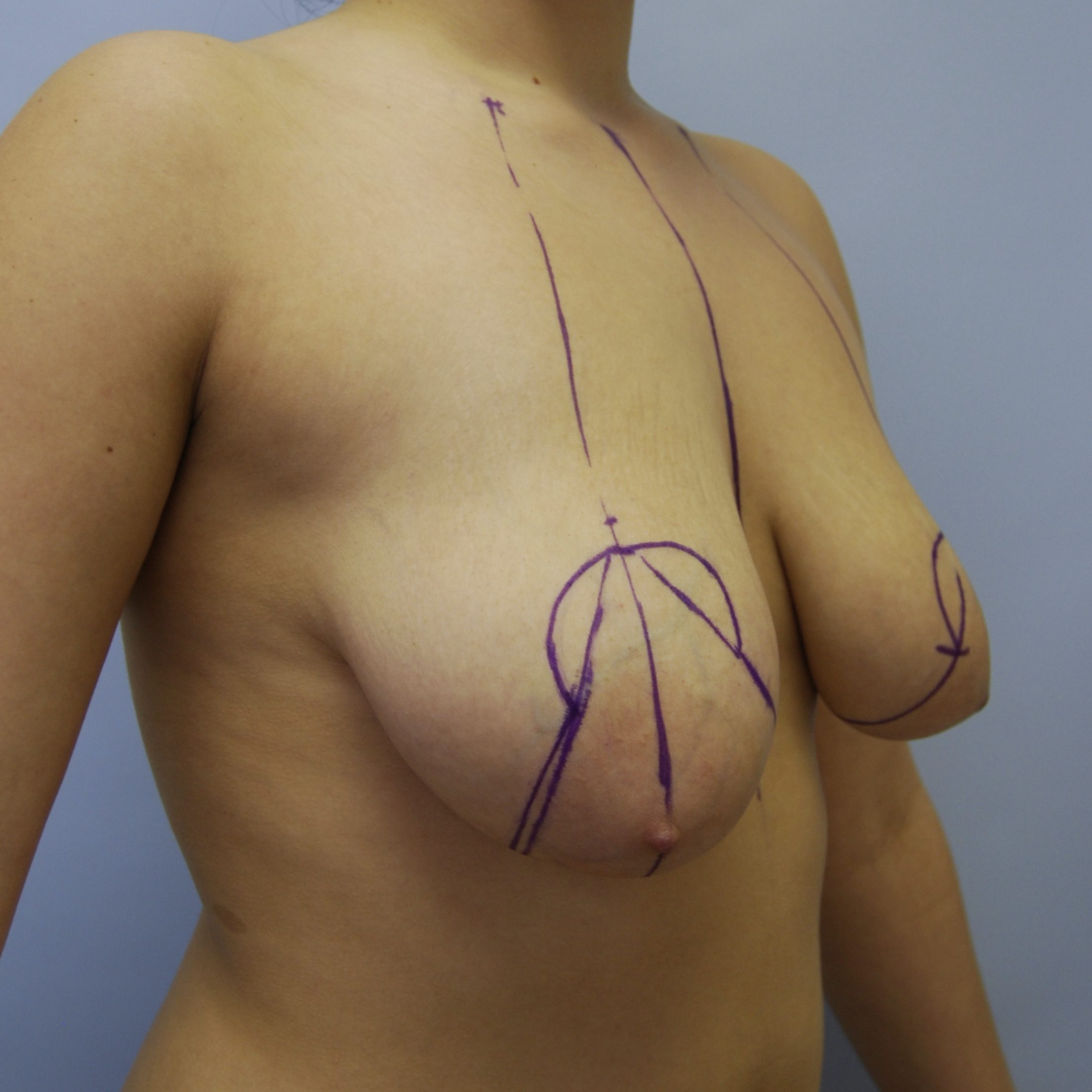 Breast Lift, Before