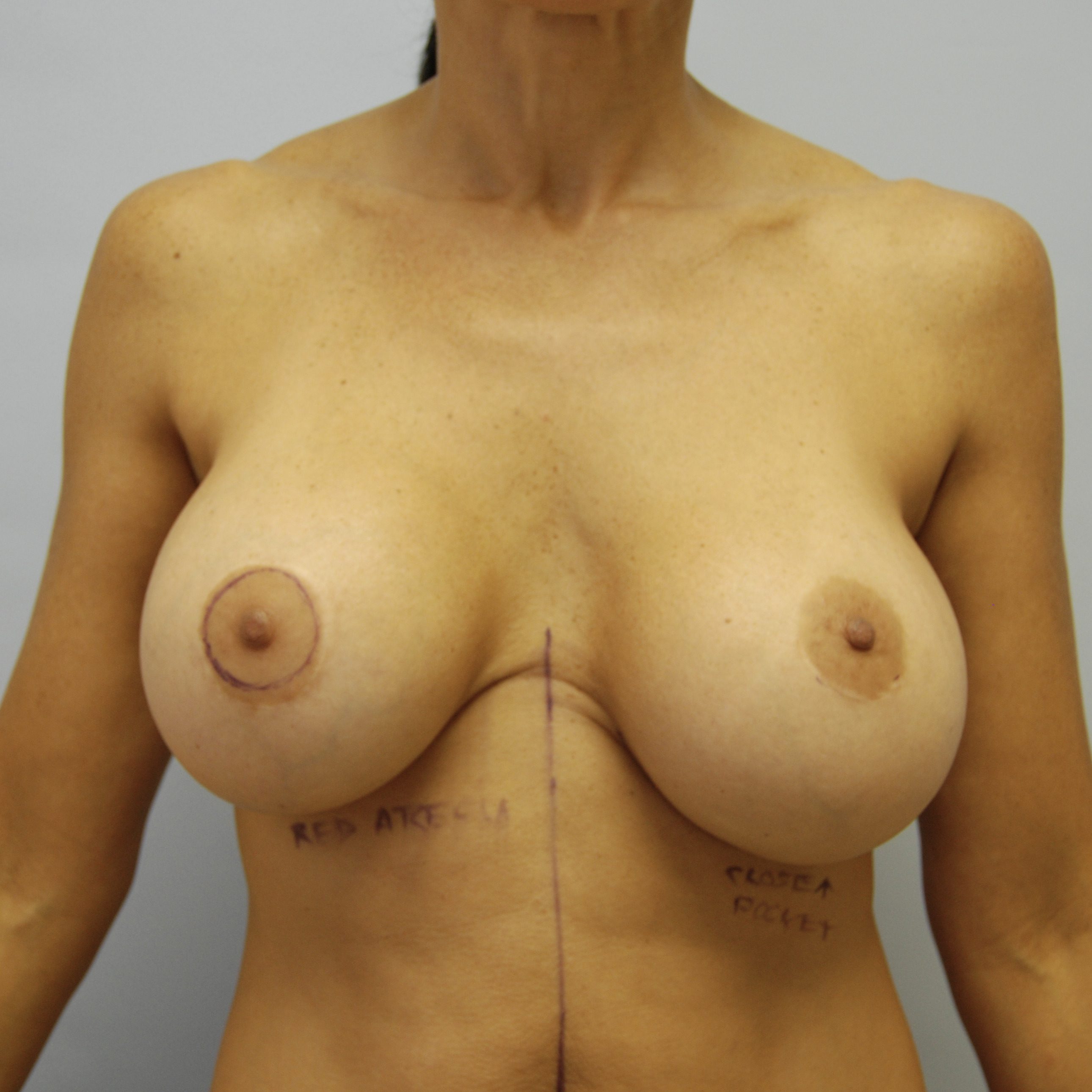 Breast Reconstruction, Before