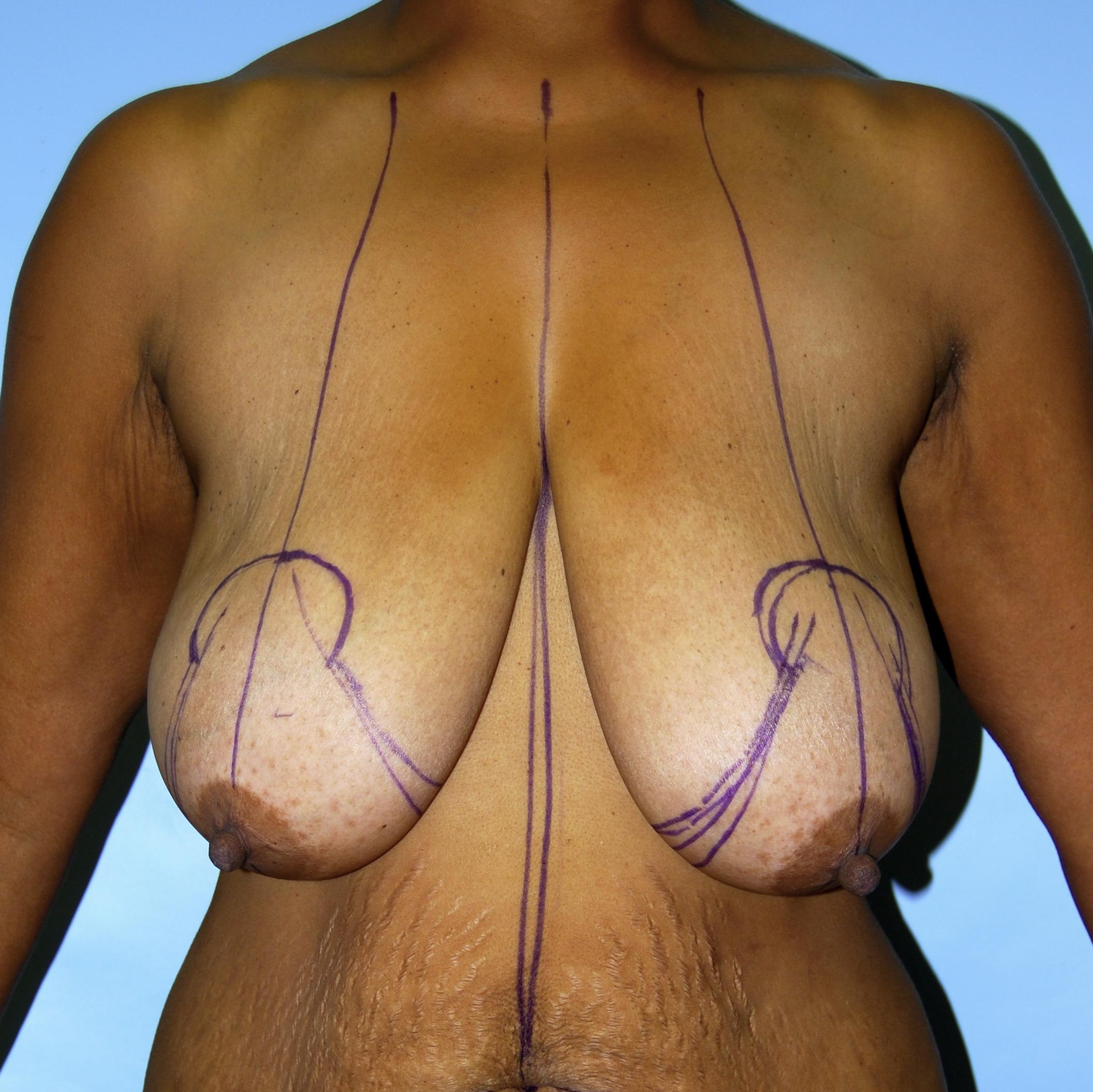 Breast Reduction, Before