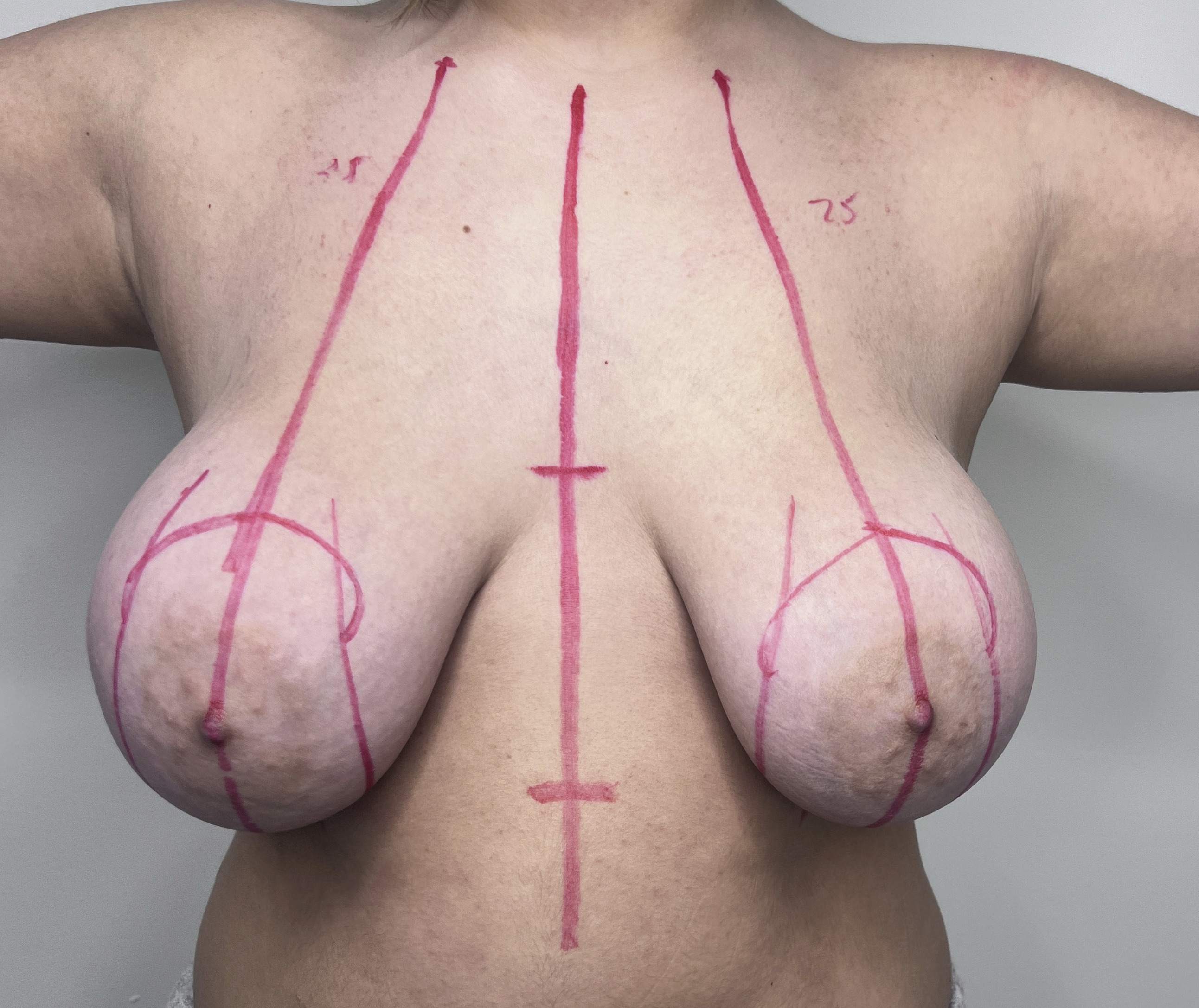 Breast Reduction, Before
