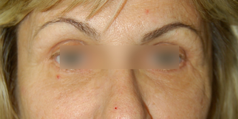 Brow Lift Surgery, After