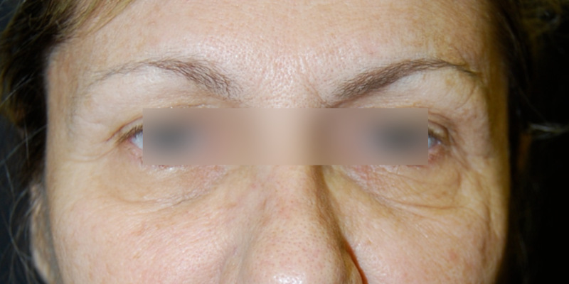 Brow Lift Surgery, Before