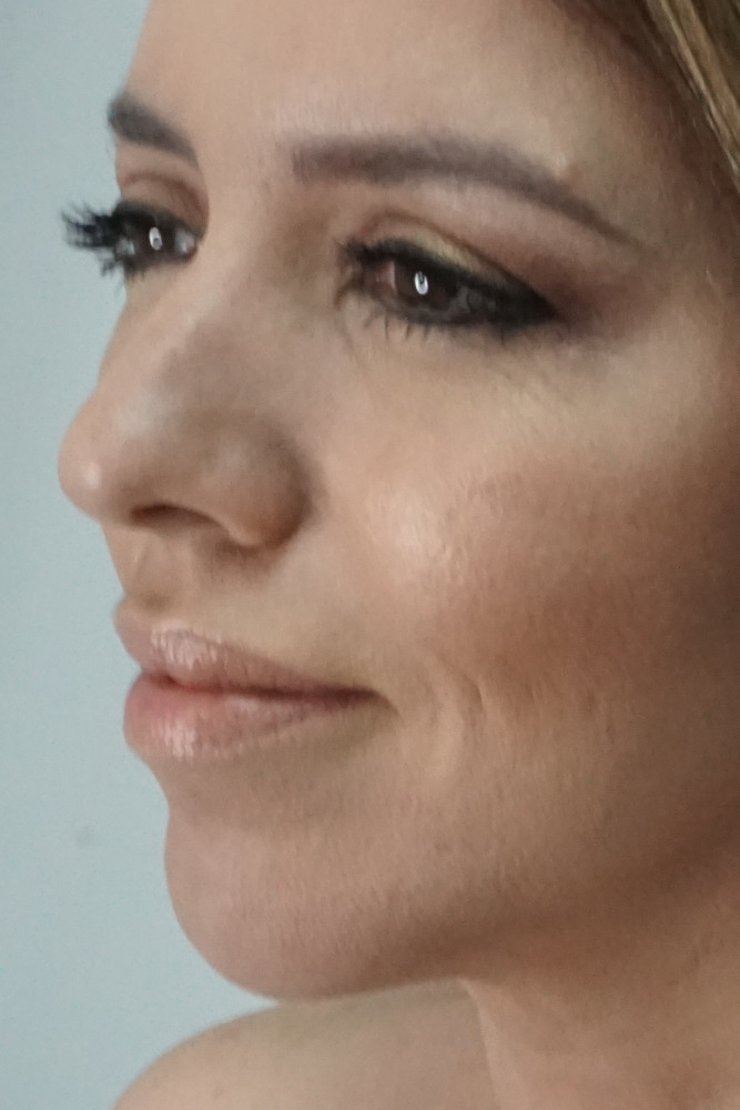 Chin Augmentation & Bichectomy, After