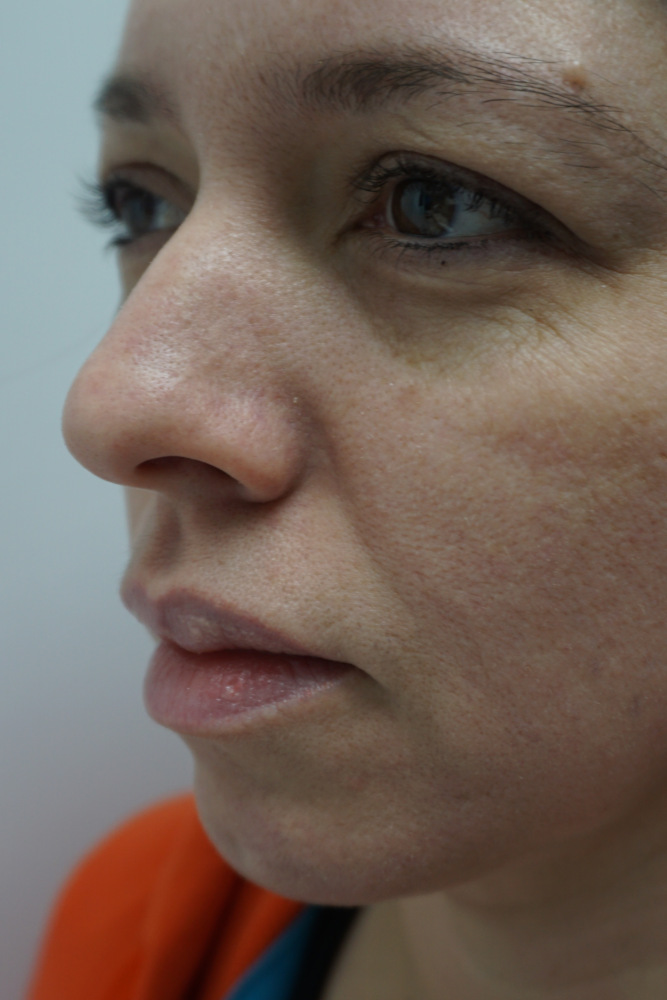Chin Augmentation & Bichectomy, Before