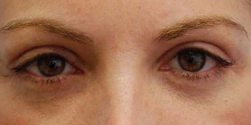 Blepharoplasty, After