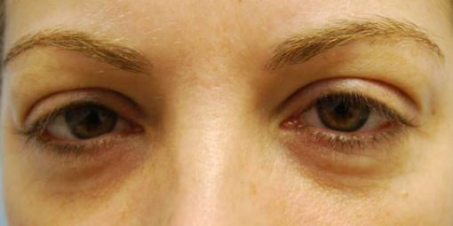 Blepharoplasty, Before