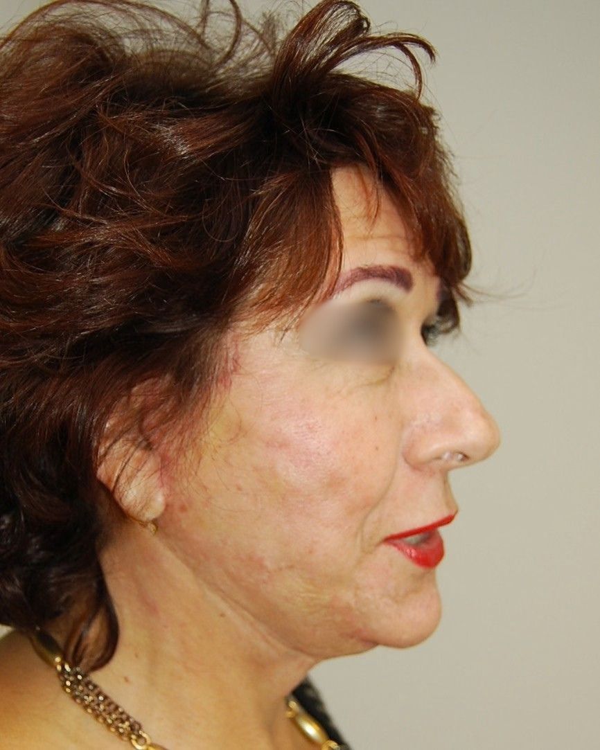Facelift, After