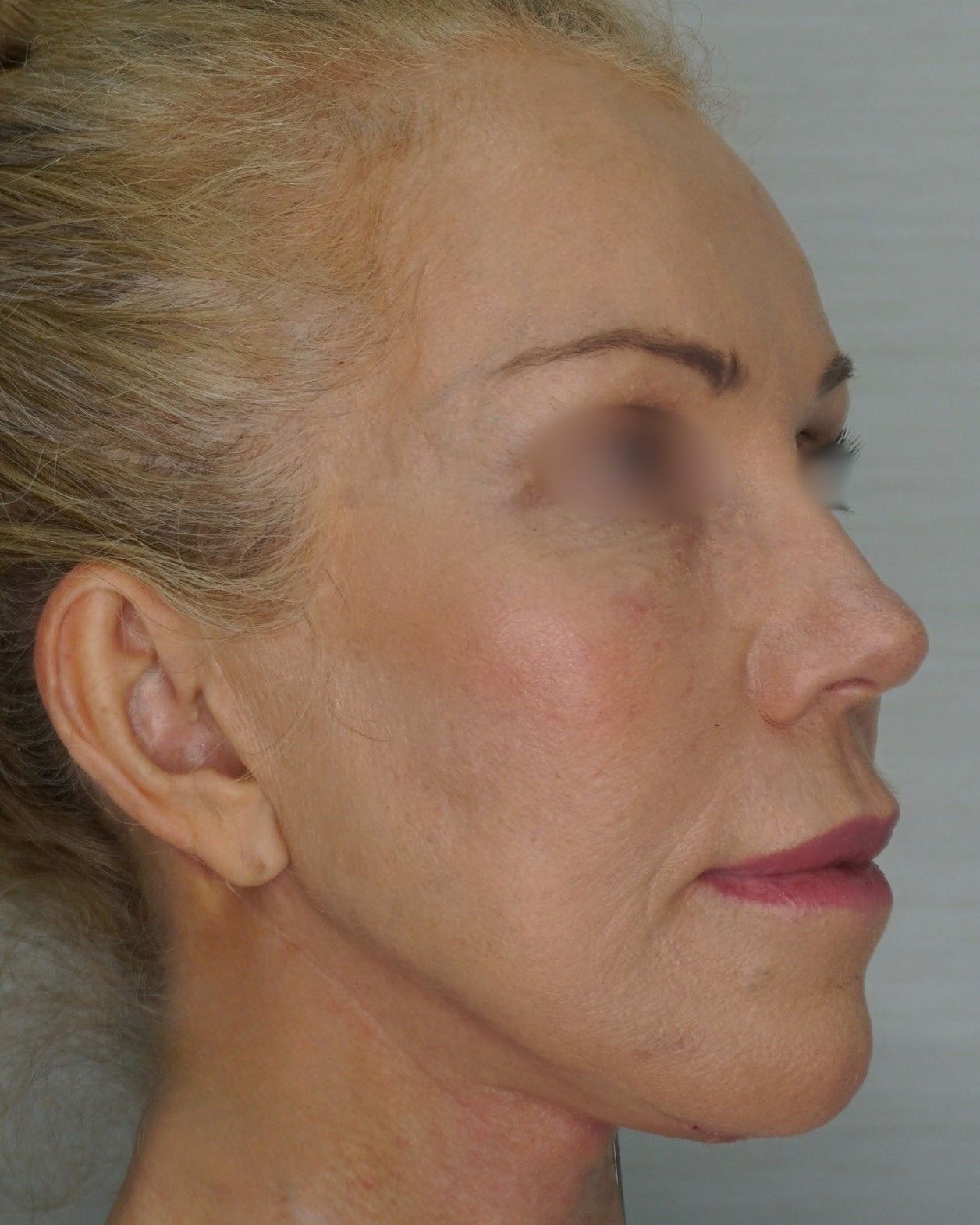 Facelift, After