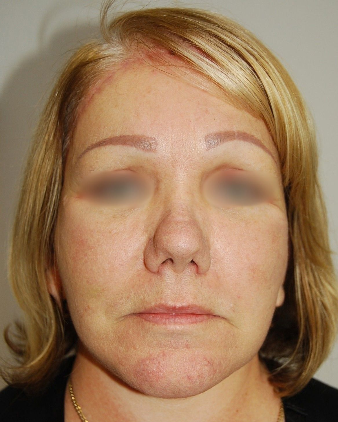 Facelift, After