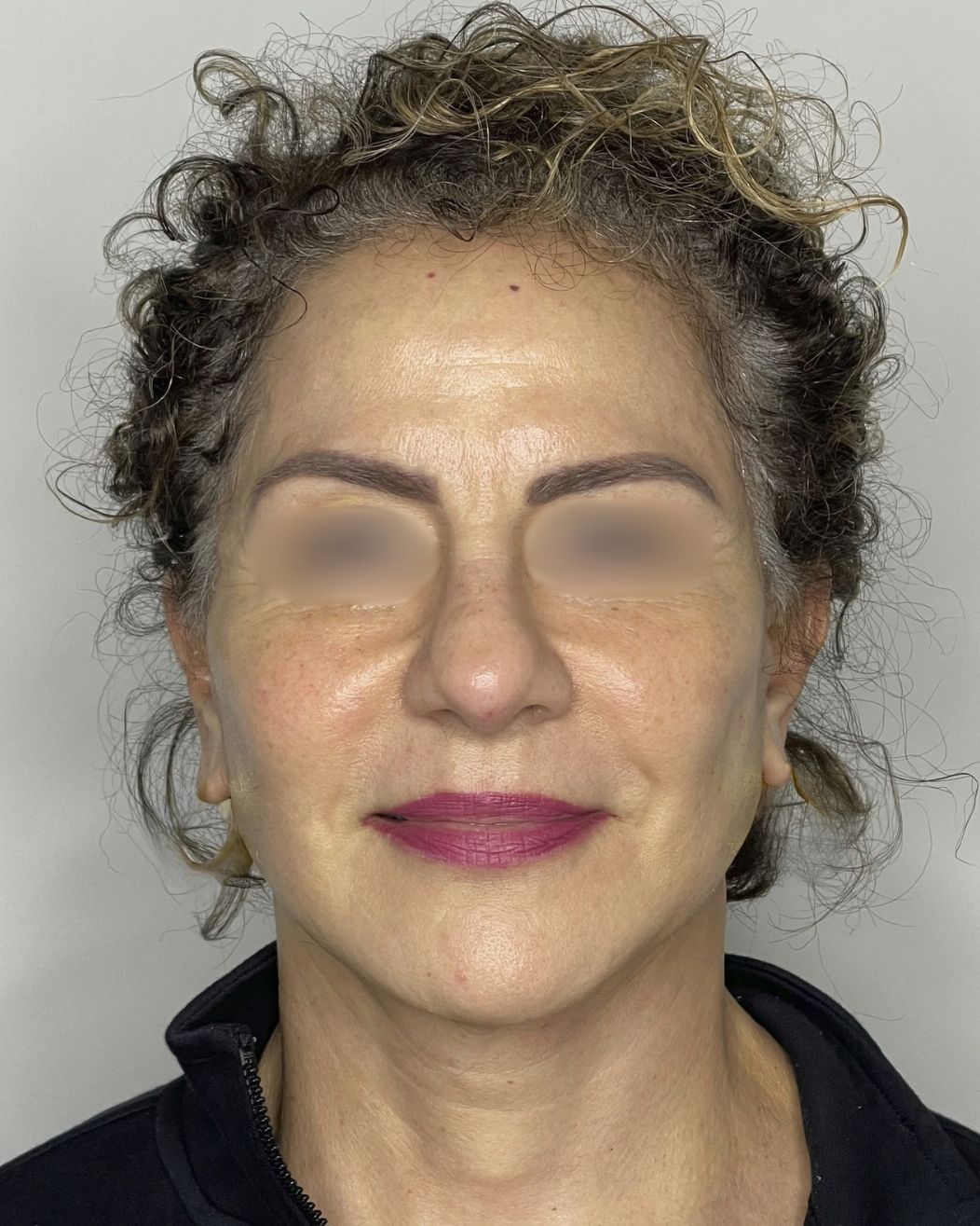 Facelift, After