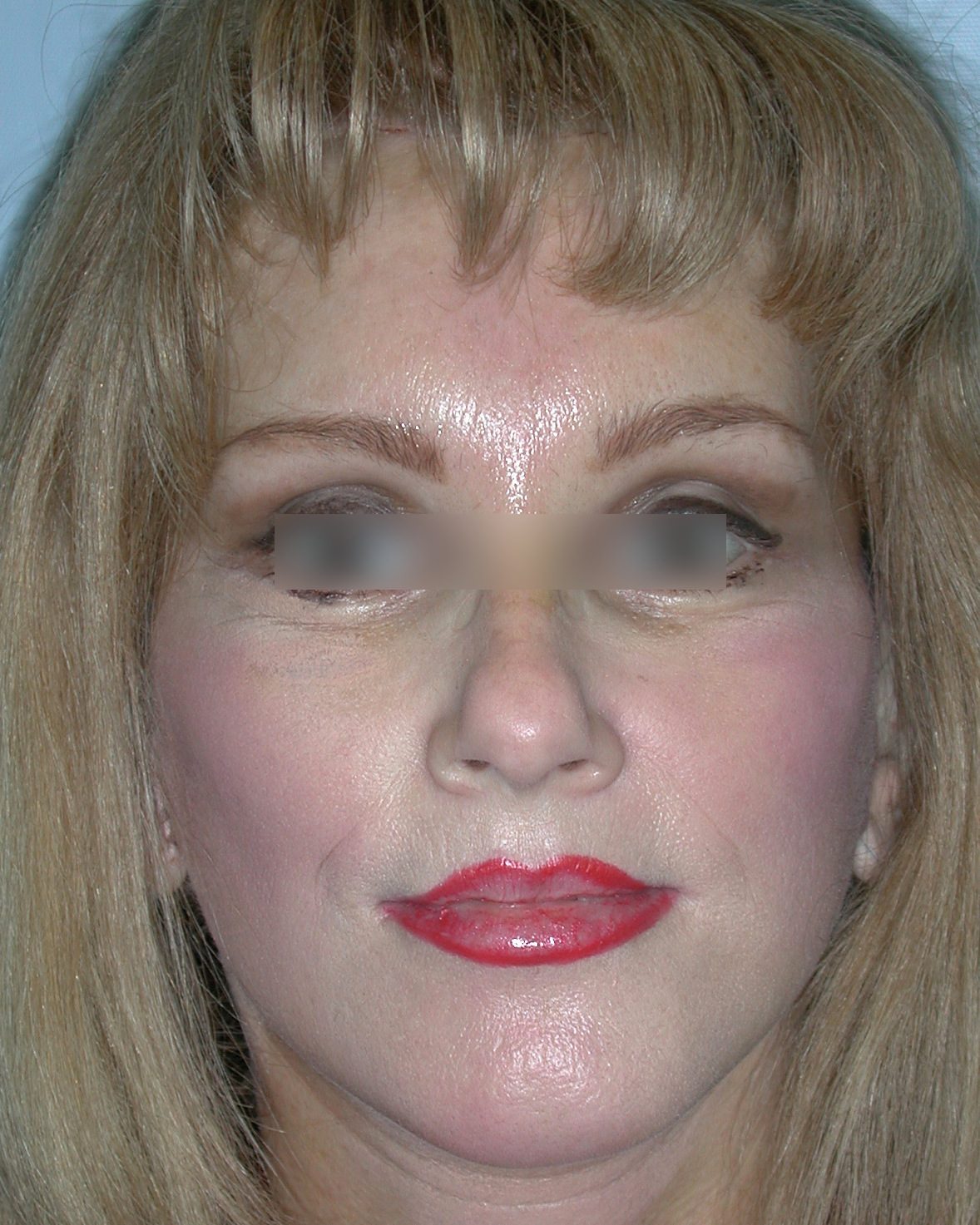 Facelift, After