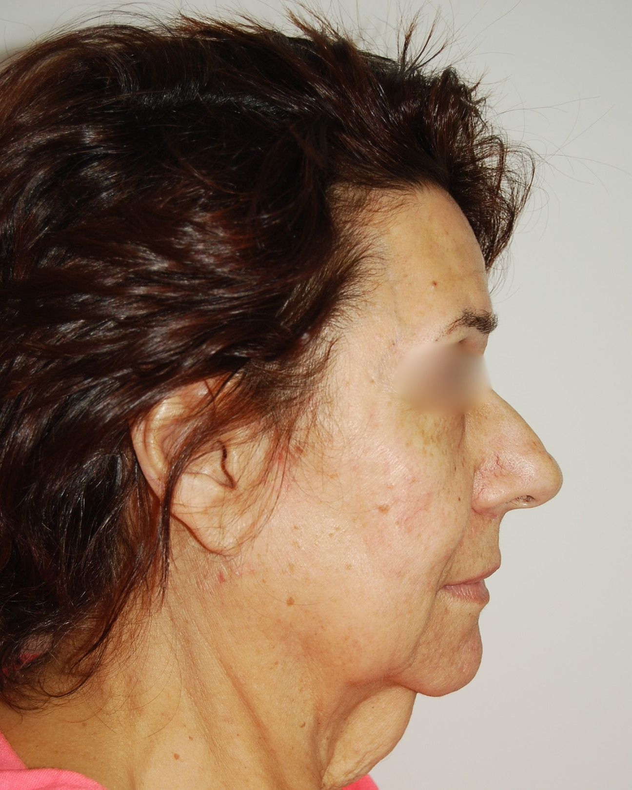 Facelift, Before