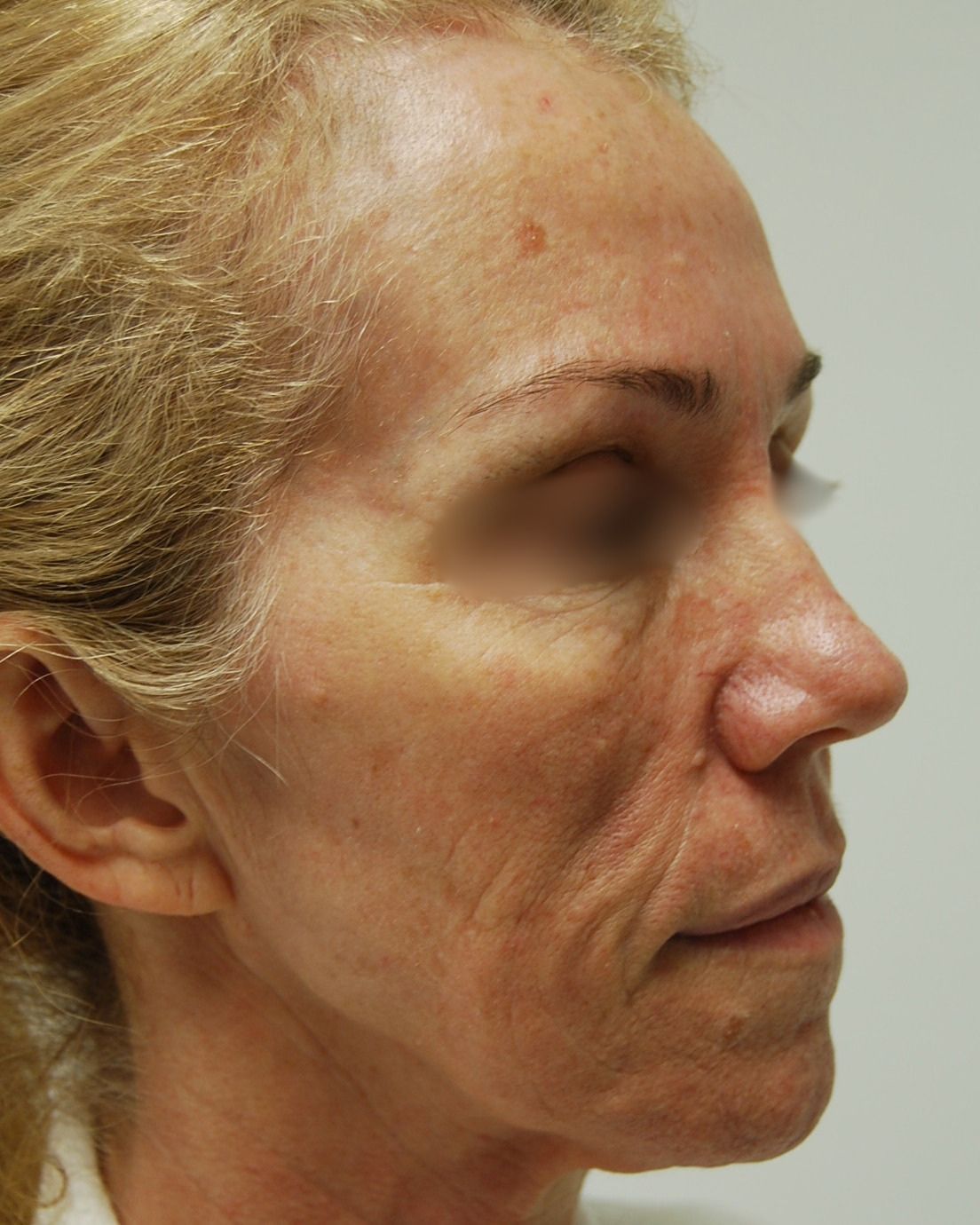 Facelift, Before