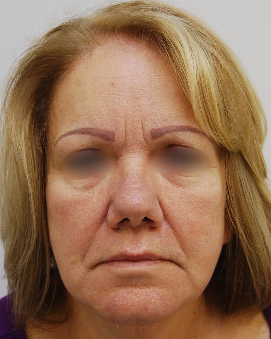 Facelift, Before