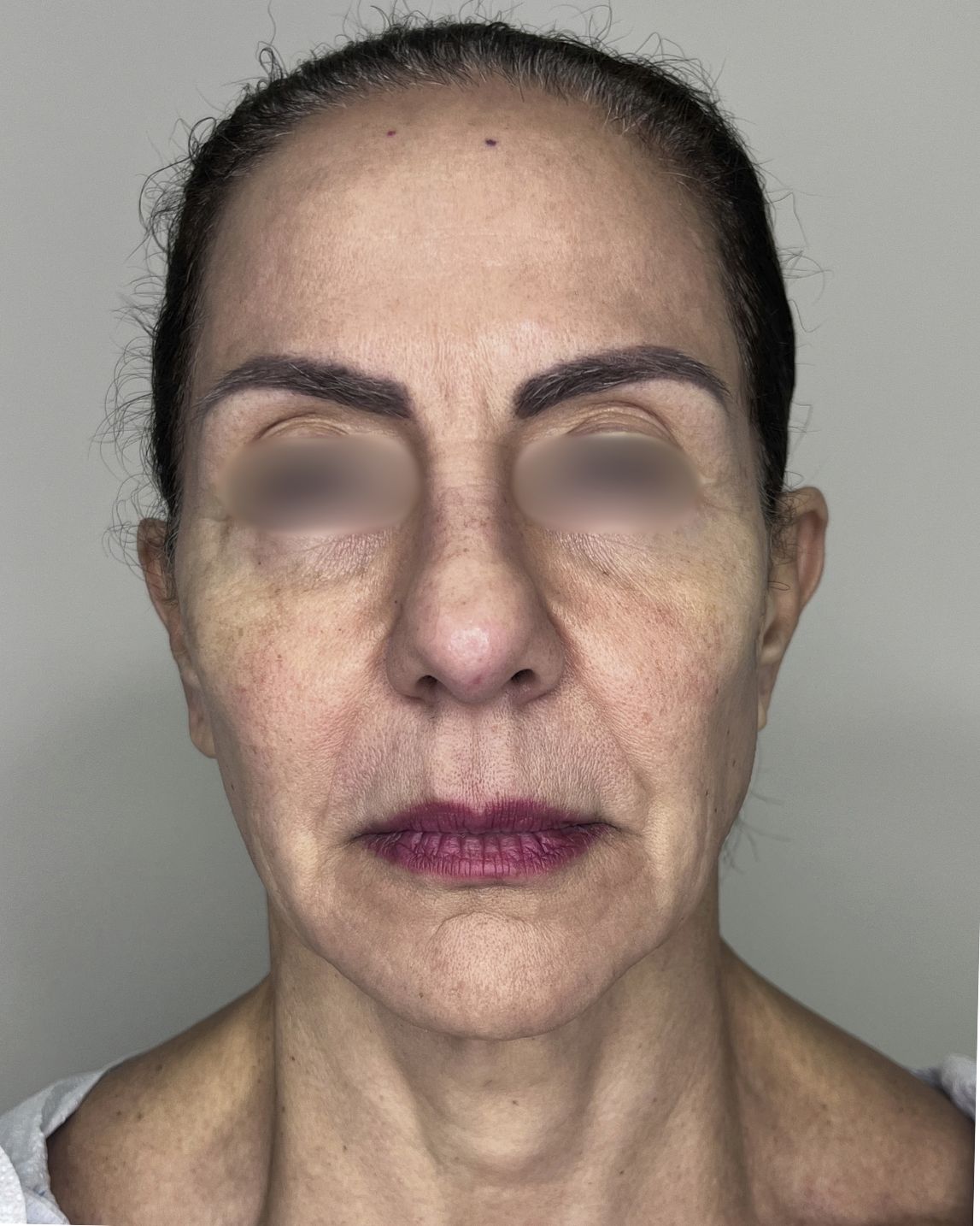 Facelift, Before