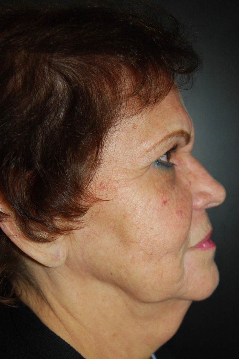Facelift, Before