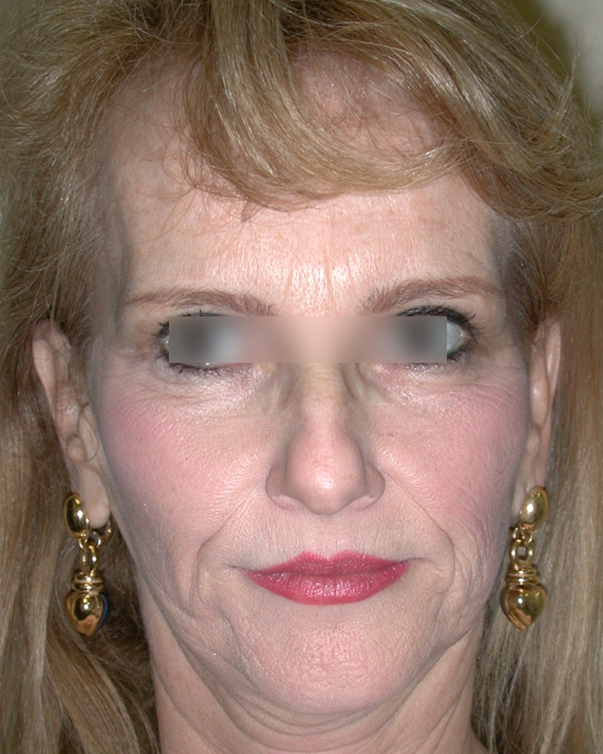 Facelift, Before