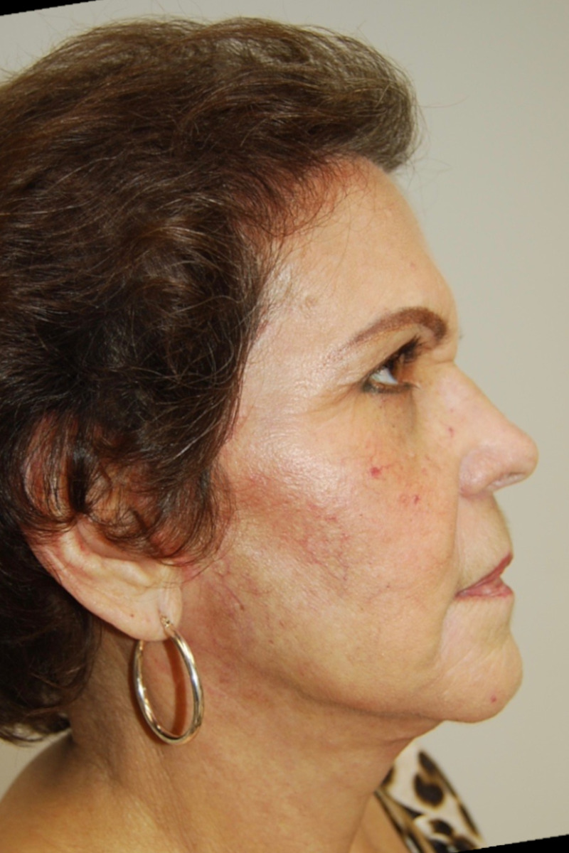Facelift
