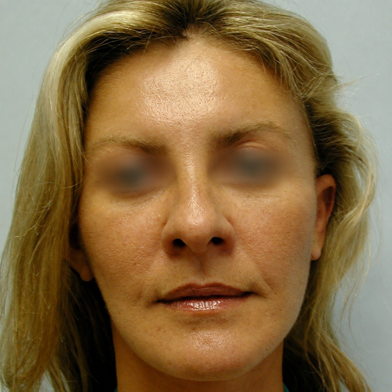 Fat Transfer to Face, After