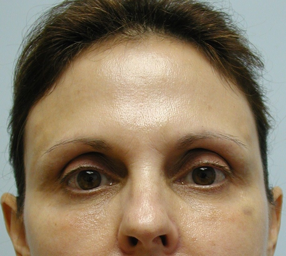 Fat Transfer to Face, After