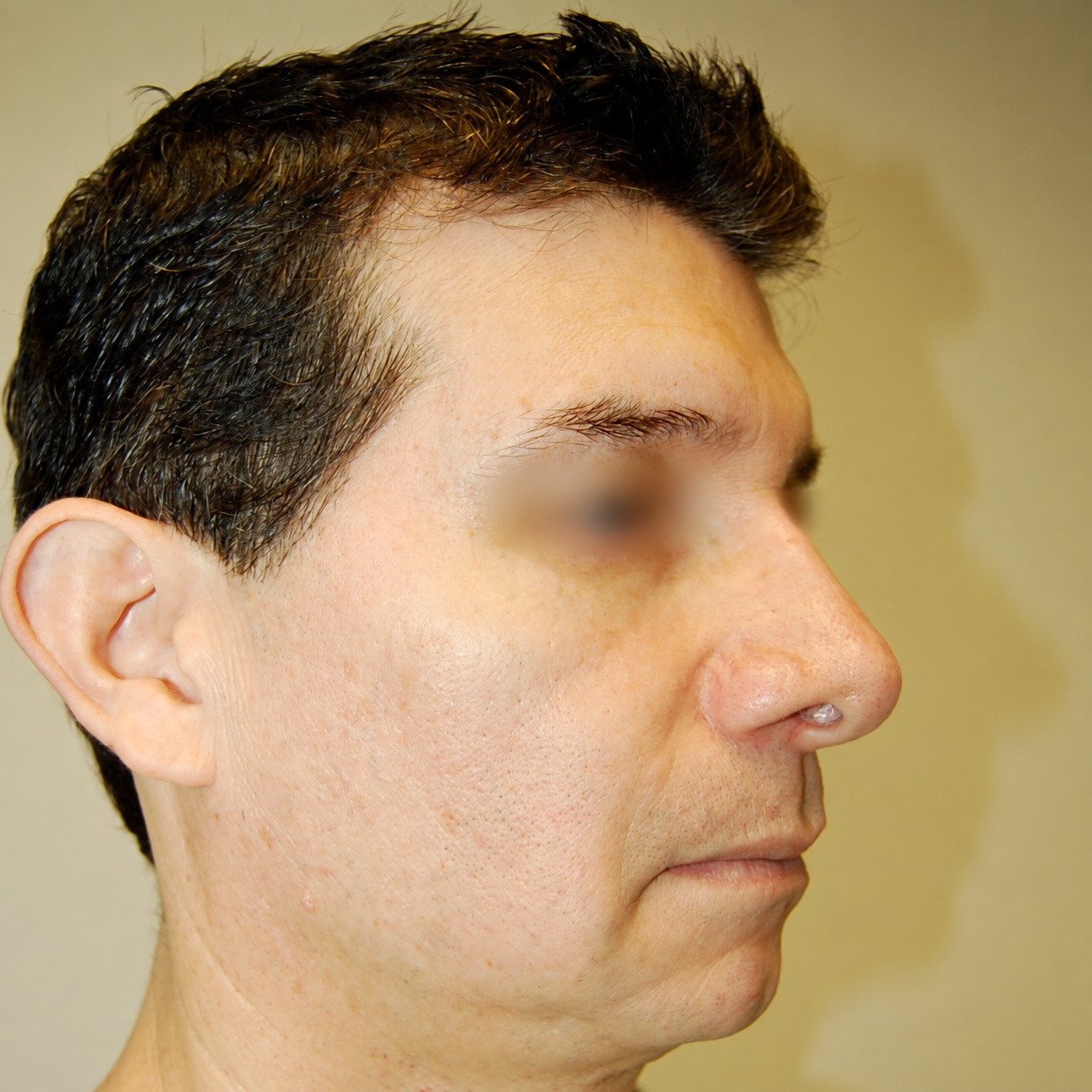 Fat Transfer to Face, Before