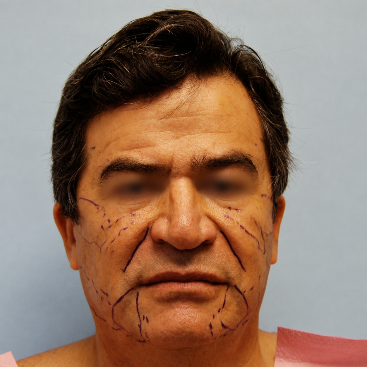 Fat Transfer to Face, Before