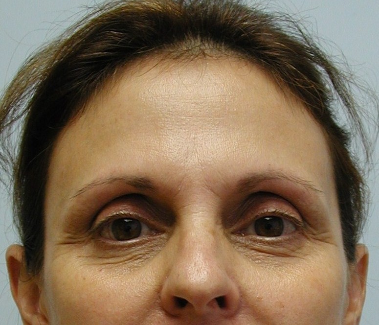 Fat Transfer to Face, Before