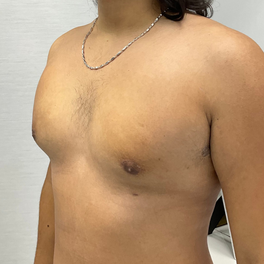 Gynecomastia Surgery, After