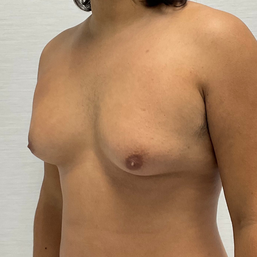 Gynecomastia Surgery, Before