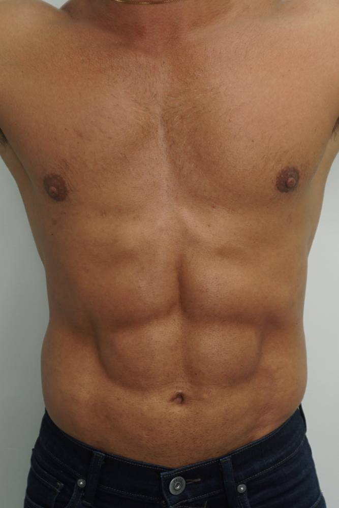 Liposculpture, After