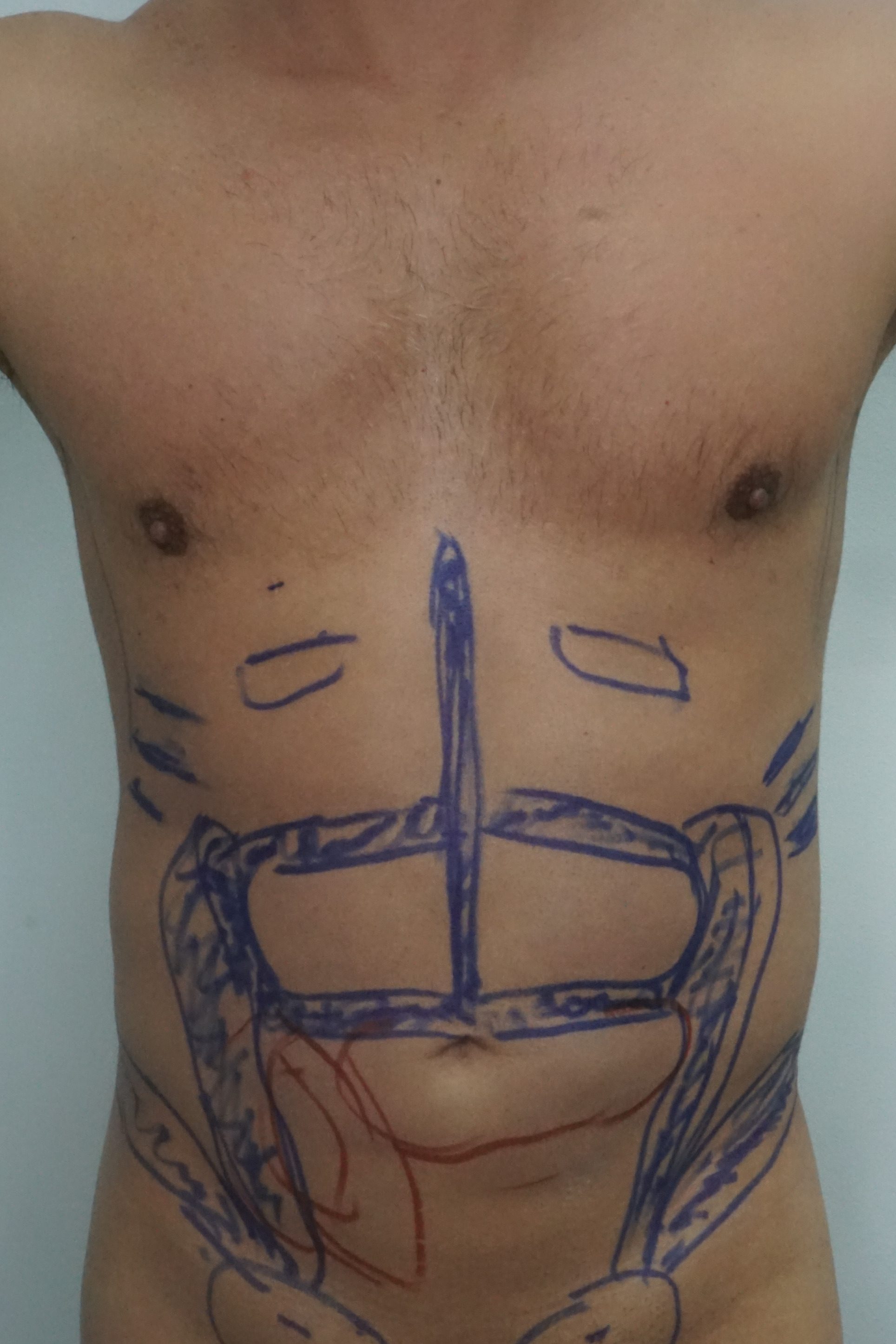 Liposculpture, Before