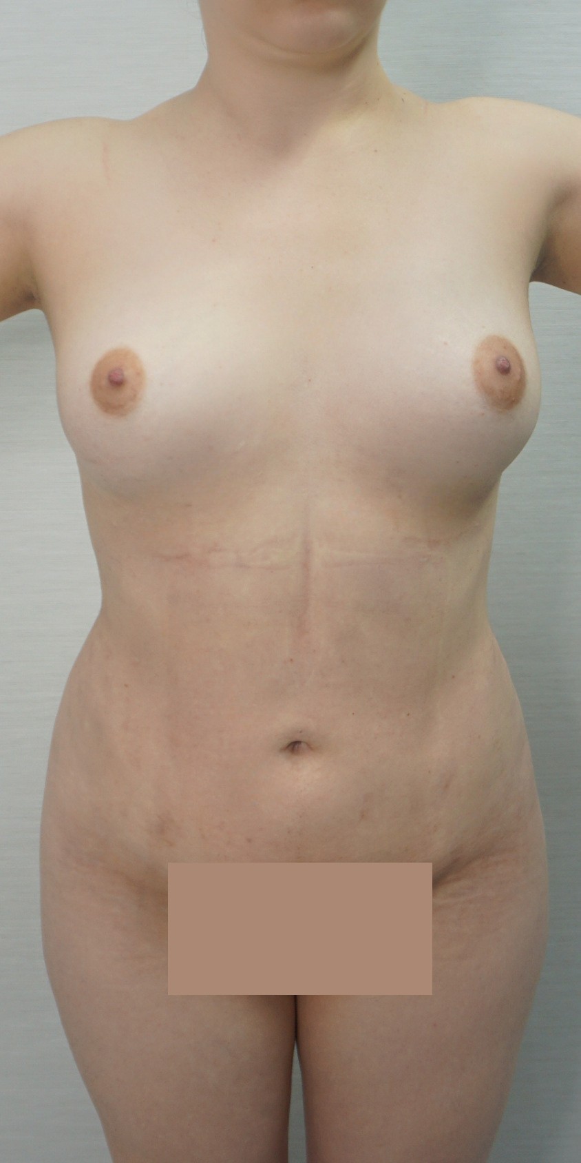 Liposuction, After