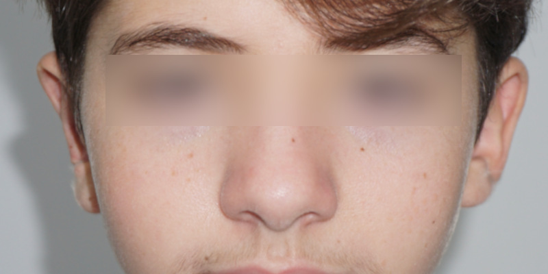 Otoplasty, After