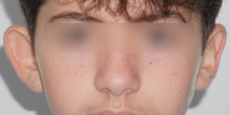Otoplasty, Before