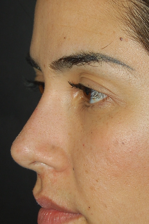 Rhinoplasty, After