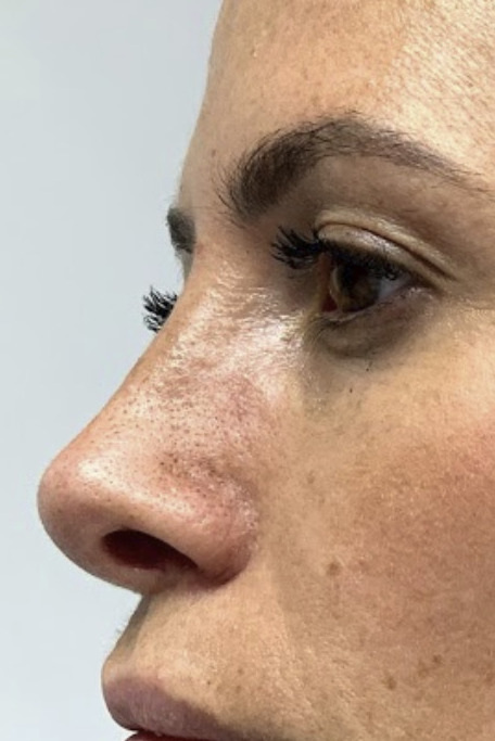 Rhinoplasty, After