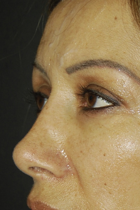 Rhinoplasty, After