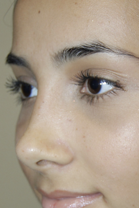 Rhinoplasty, After