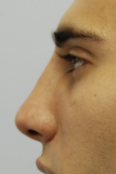 Rhinoplasty, After