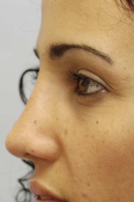 Rhinoplasty, After