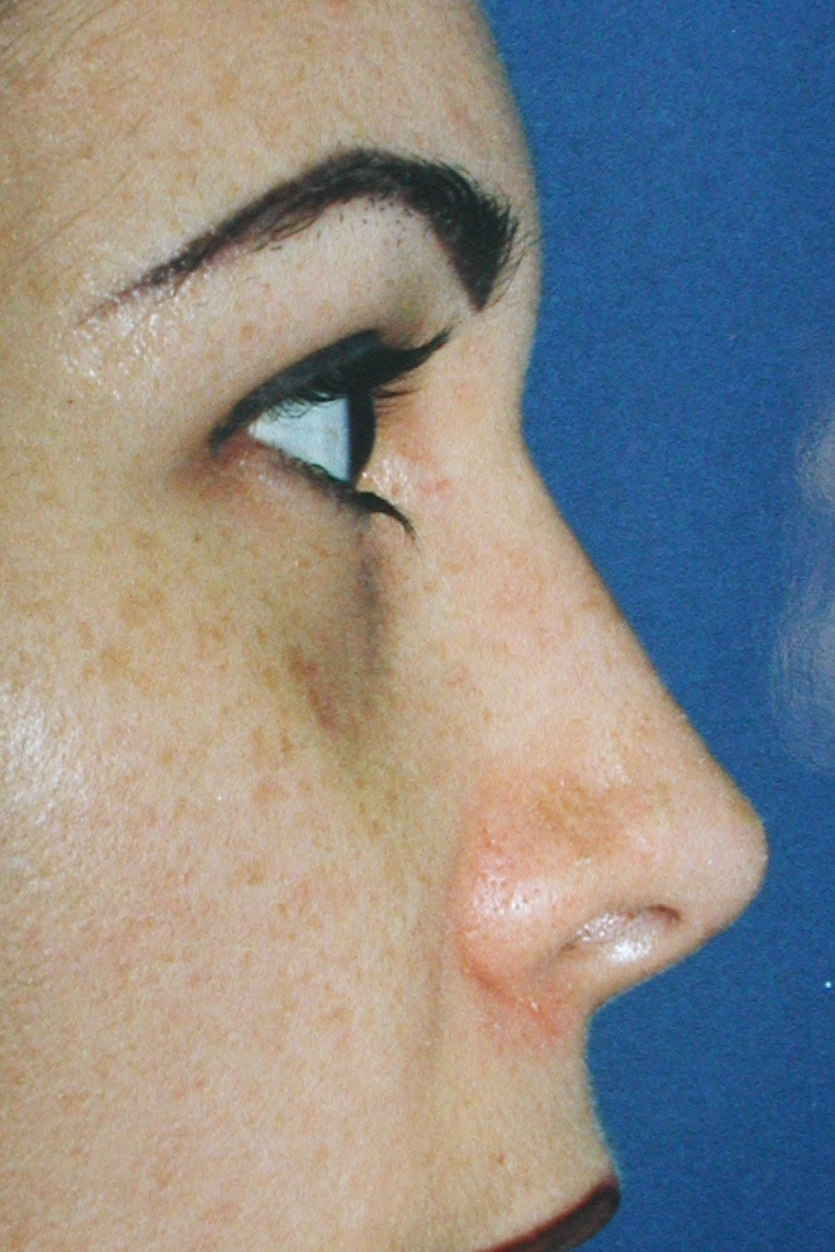 Rhinoplasty, After