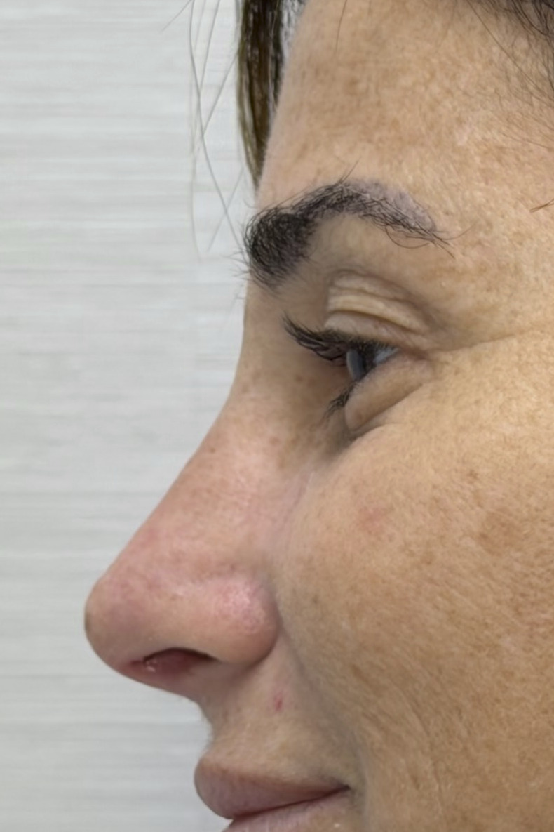 Rhinoplasty, After